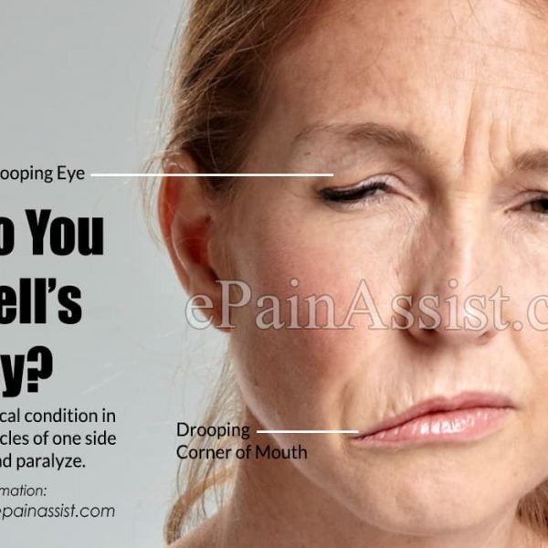 Woman with facial paralysis