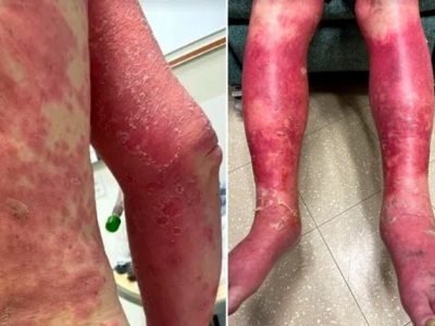 Man suffers sever skin reaction to vaccine