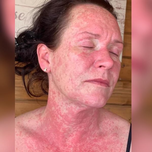 Woman suffers rash after AstraZeneca vaccine